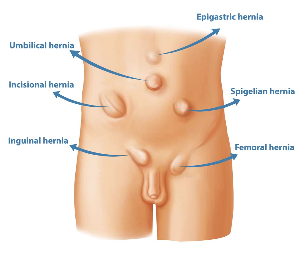 HERNIA TREATMENT IN KALYAN