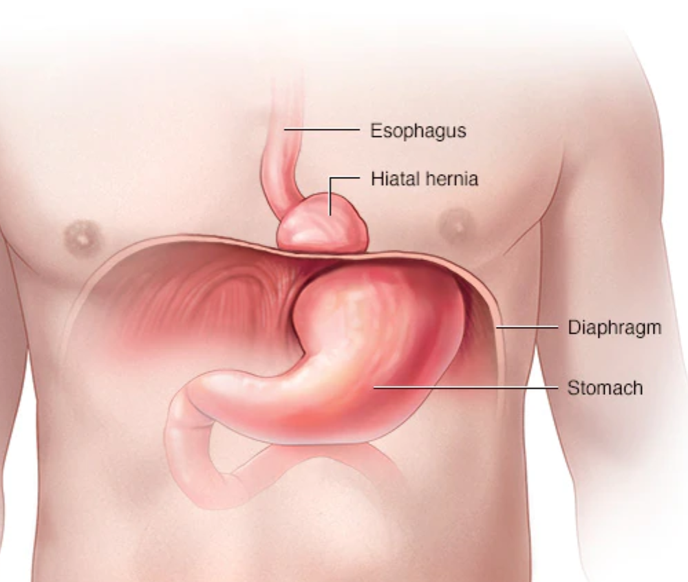 HIATUS HERNIA TREATMENT IN KALYAN
